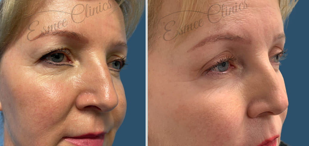 Before and After img